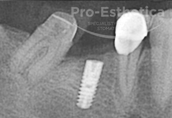 implanty-dentystyczne-warszawa-06c